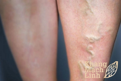 Bị nổi gân xanh ở chân là mắc bệnh gì?
