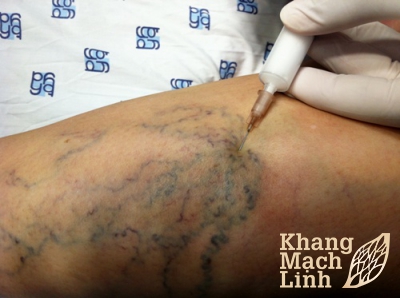 Tổng hợp 5 cách trị suy giãn tĩnh mạch phổ biến nhất hiện nay