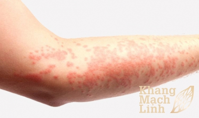 Khoảng 25 – 50% bệnh nhân viêm mao mạch dị ứng biến chứng viêm thận cấp