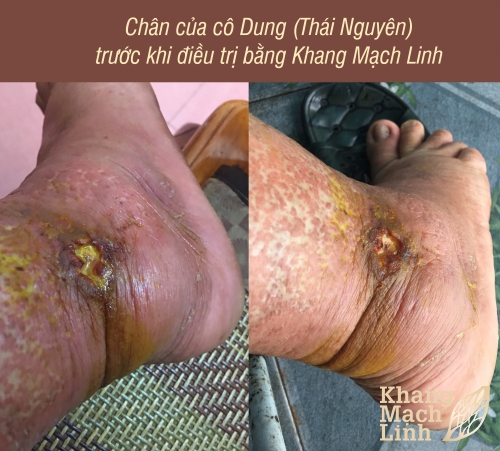 Cô Nguyễn Thị Dung (ở Thái Nguyên) và căn bệnh viêm mao mạch hoại tử